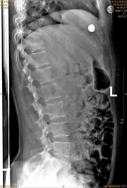 沙发    wwsh901      wwsh901   胸腰段正侧位片