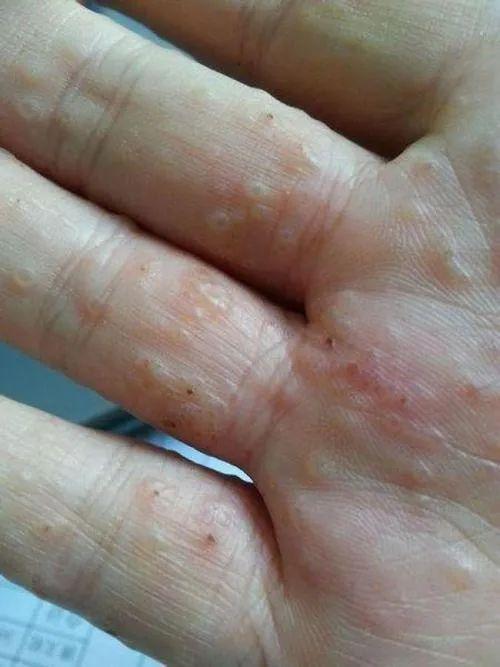汗疱疹发病期间切勿刺激患处,比如挠痒,摩擦或接触一些有刺激性的物品