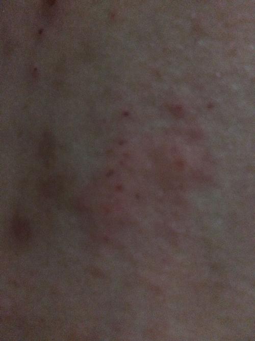 请问皮肤专家这是什么病身体某些部位突然骚痒一阵一