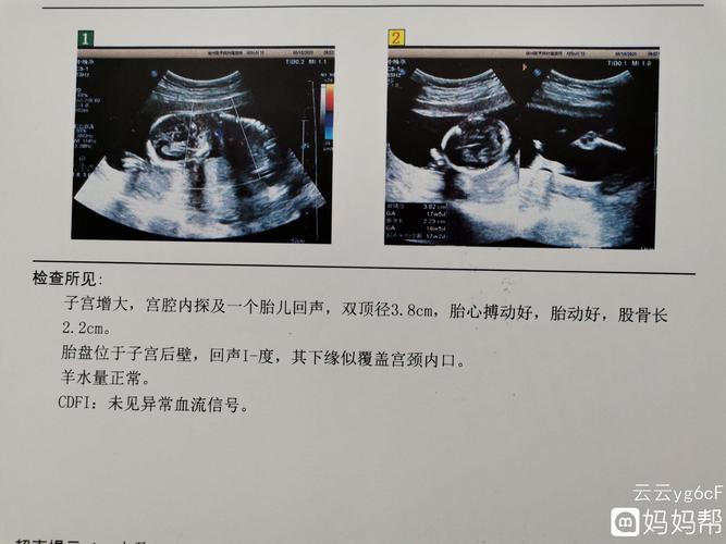 17周家的彩超可以看出是男宝女宝吗