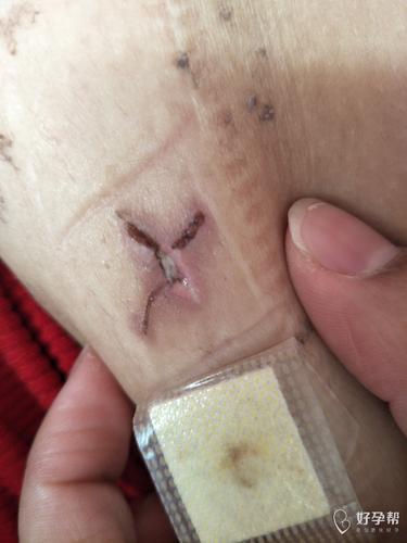 11月30号做的宫腹腔镜,现在伤口上有白色的