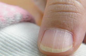 注意!这几大癌症都表现在指甲上了