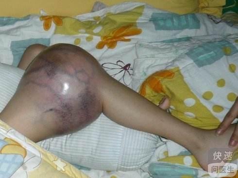 小孩为什么会得骨癌 详述小孩骨癌的原因