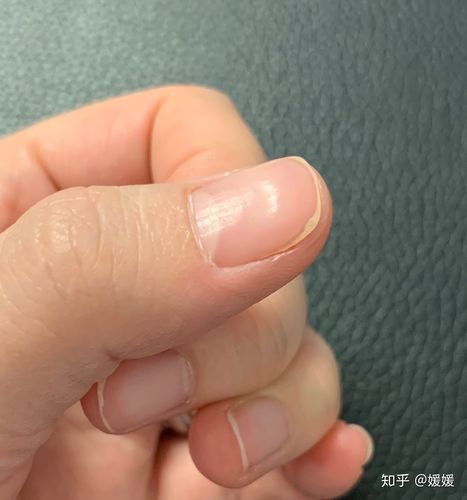 指甲突然有个一条横纹,是怎么回事?