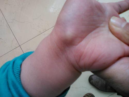 我五岁的儿子手上有个小包,给医生看有的说囊肿,有的说是肉瘤,我要求