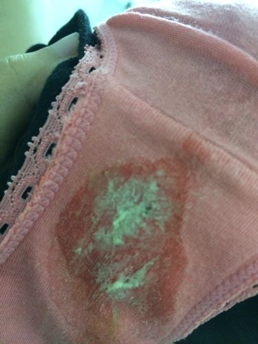 白带正常吗 不痒