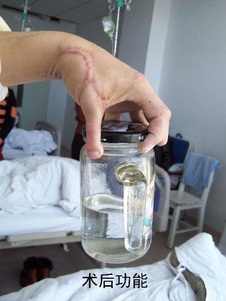 第2足趾游离移植再造拇指术