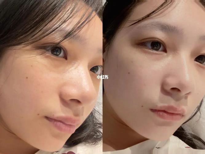 学生党第一次做光子嫩肤祛斑 期待效果呀_祛斑_光子嫩肤_学生党_沈阳