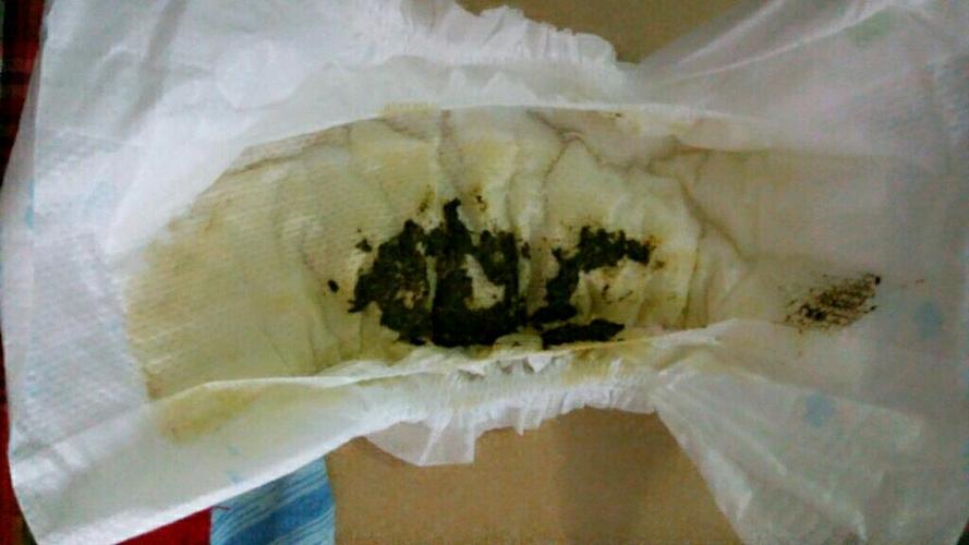 宝贝黄疸吃茵栀黄大便成这个样子,正常吗?看着很干!有图慎入