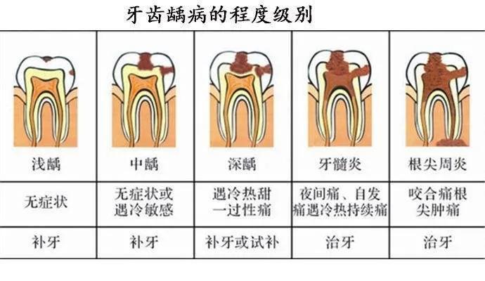1,术前拍摄x线片 在根管治疗过程中,在根管治疗术前拍x线片,以帮助