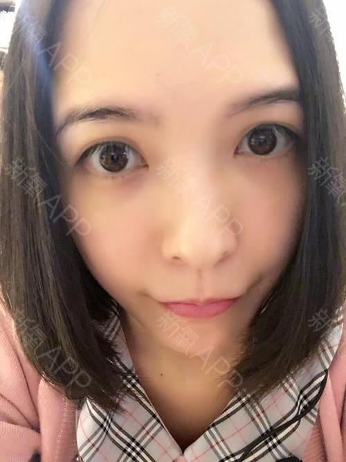 打完第四天我额头还是有一点点小细纹