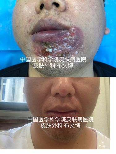 化脓性汗腺炎可以治疗,可以治愈
