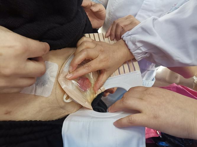 关爱造口人士,重塑幸福生活