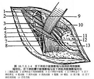 面-舌下神经交叉吻合术