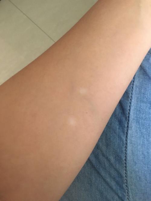 手腕上长了一个小白点有黄豆大小有1年了,前几天发现四肢上也长了几个