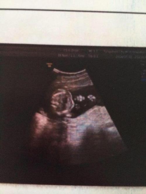 怀孕18周的胎儿是什么样子的?很多准妈妈还不清楚,早