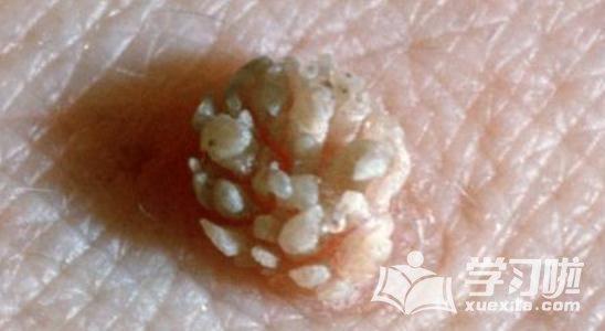 疣是什么原因造成的_导致长疣的病因有哪些