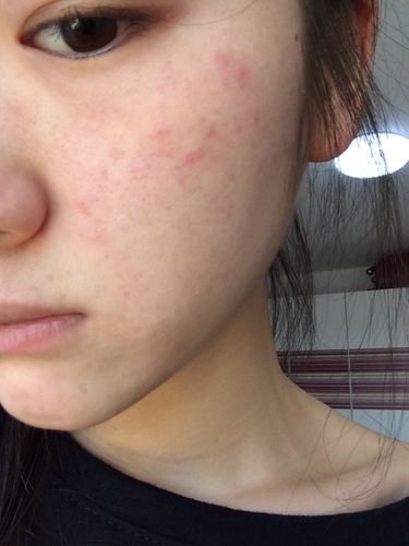 我怀孕,脸上总是好痒,还起小米粒一样的小红点点,红疹子一样什么回事