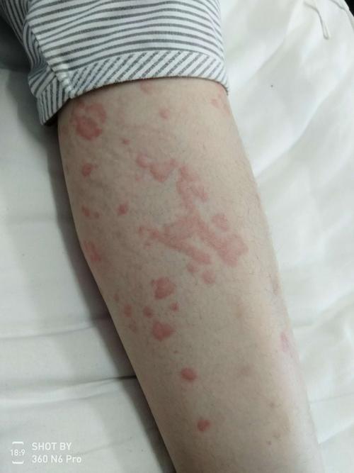 荨麻疹-系统性红斑狼疮康复圈-觅健