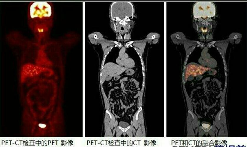 啥是佩奇,petct来告诉您
