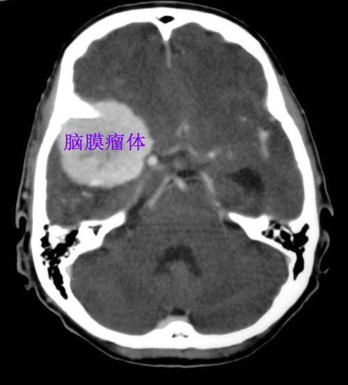头颅ct图中显示右侧有个大大的脑膜瘤