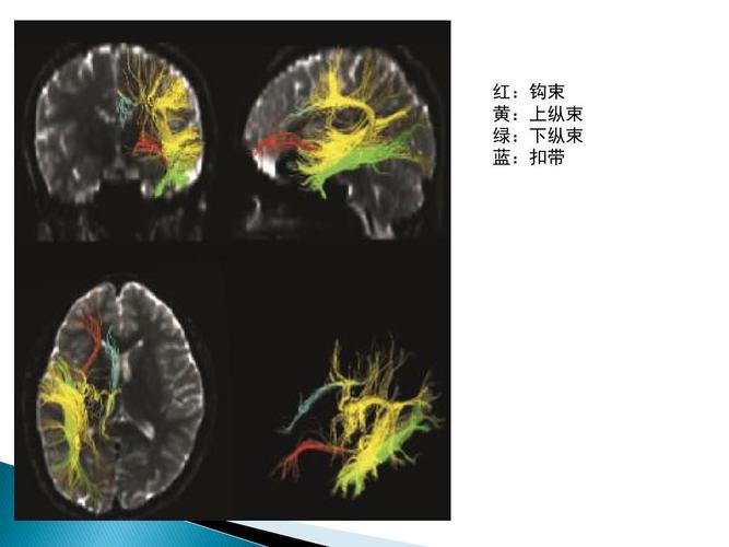 脑白质解剖