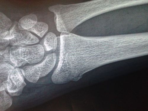 我这骨折严重吗?检查