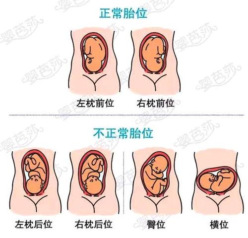 胎方位左枕前位是什么意思