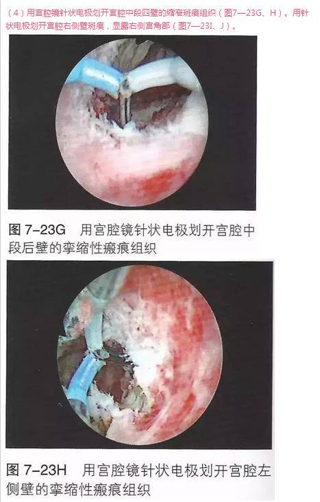 【病例分享一】宫腔镜宫腔粘连电切术