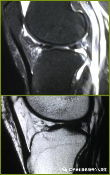 膝横韧带3外侧半月板右角偏向内侧,向头侧倾斜,因此在短te时会因魔角