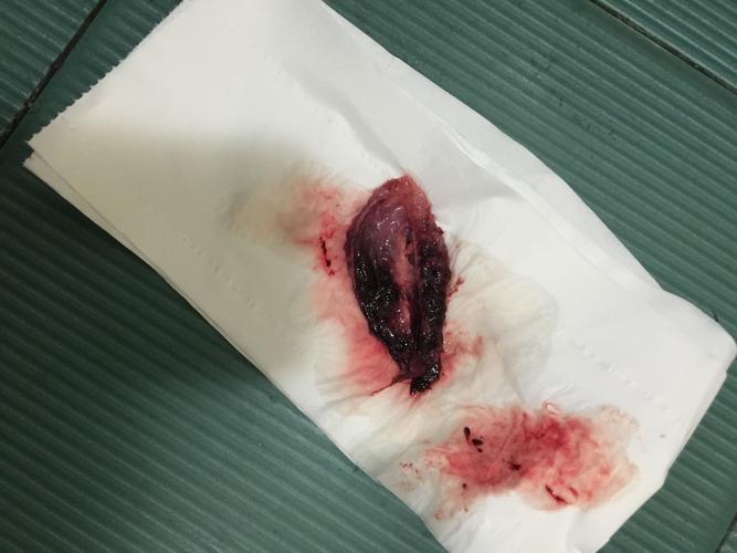 [试管婴儿]有图慎点,刚刚排出来的是孕囊吗?排出来之前肚子坠着疼