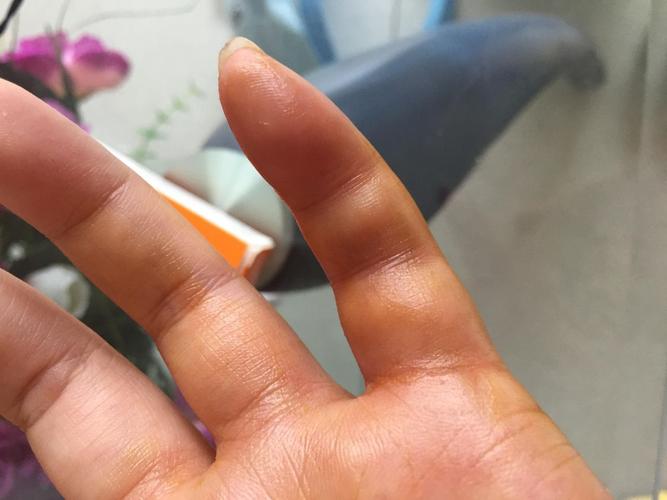 原创糖尿病来临前,手部会有3种异常表现,为了健康,需注意