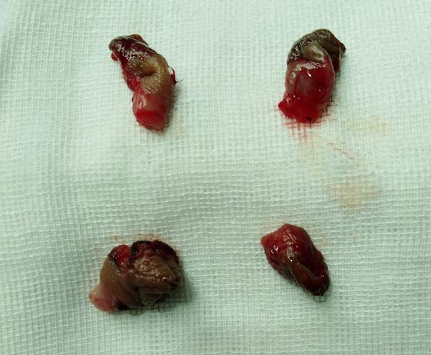 痔疮 出血,若不及时治疗,可慢性失血,导致严重的 贫血