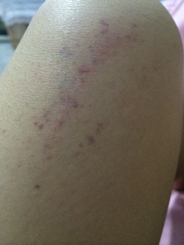 今天突然看见孩子腿上起的,发紫!