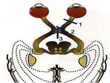 >>视交叉病变概述