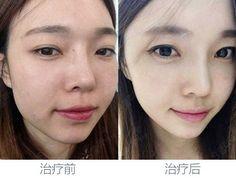 2019年人物对比_案例  采集 xmvmax.com 水光针 xmvmax.com