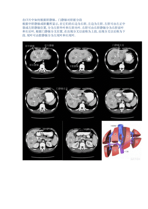 肝脏在ct中的分叶.docx 10页