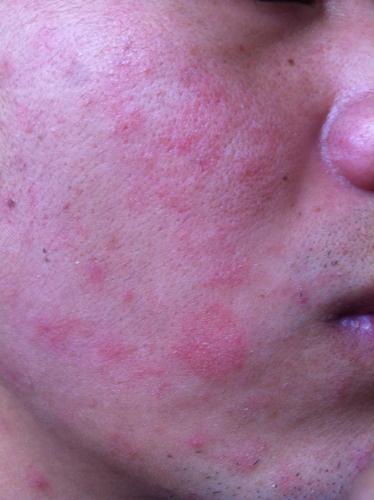 问:脸上起皮,皮下面就是红色斑点?也不痒痒,这是皮肤癣吗?