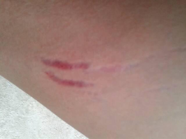 请问这是膨胀纹吗,不痛不痒的,它会越来越多吗,有什么