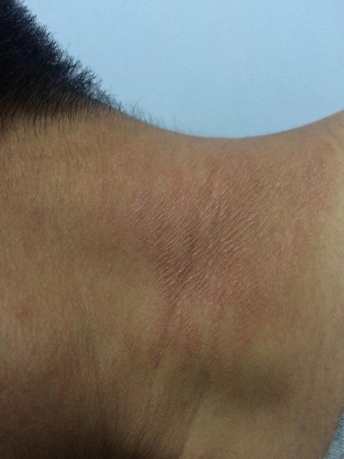 脖子很痒,请问这是神经性皮炎吗,用羚锐止痒灵抑菌膏有效吗?