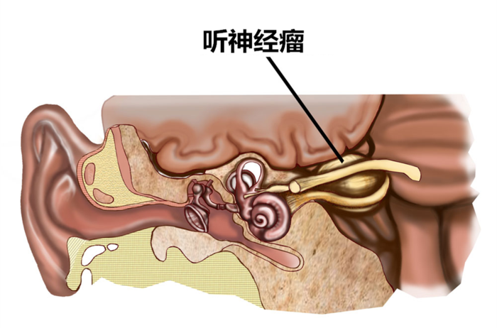 耳鸣,眼睛胀痛,面部发麻以为是脑梗,却检查出听神经瘤!_手机搜狐网