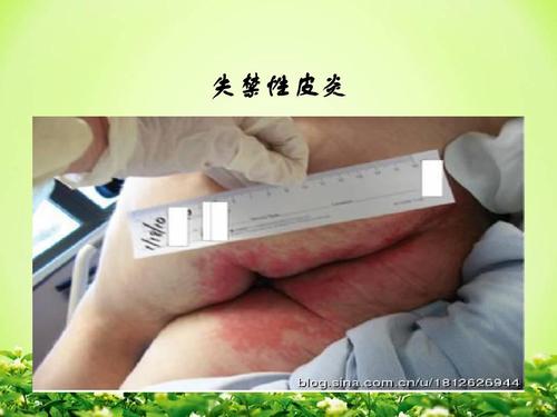 失禁性皮炎