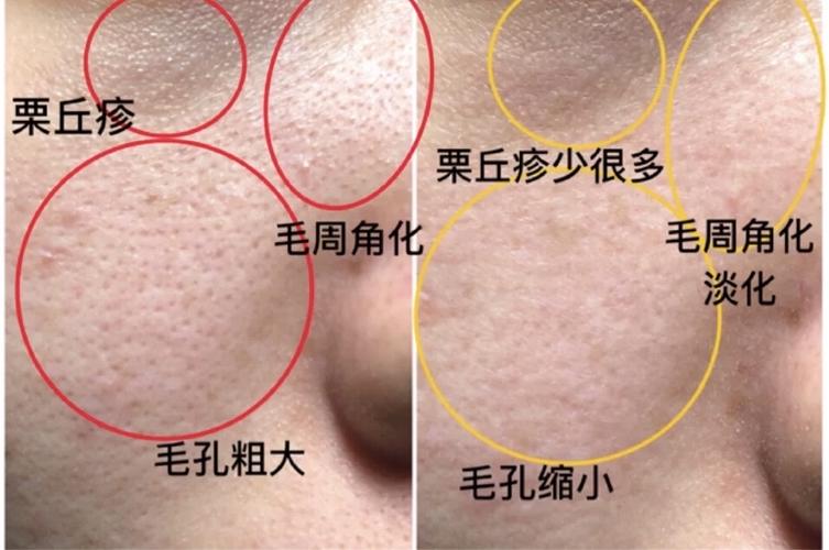 有姐妹眼部有栗丘疹和毛周角化的嘛