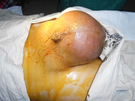 腹股沟疝多大才算大