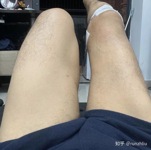 现在是术后第三周了,不拄拐其实也能走路,只是大腿肌肉萎缩的很厉害