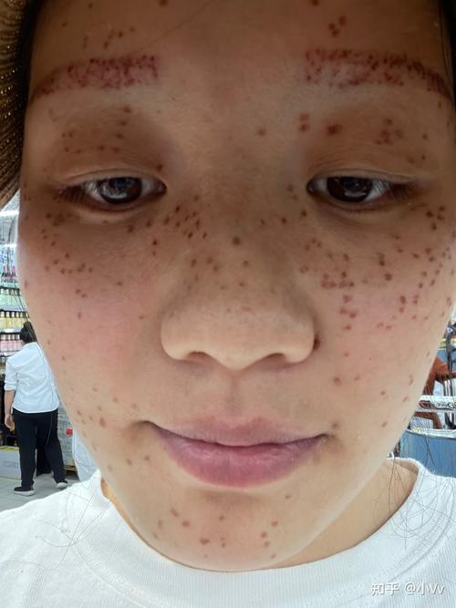 药水点斑真实图片不知道算不算是成功了反正身边人都说我这个成功了