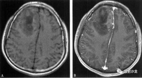 明显强化主要见于脑外肿瘤和胶质母细胞瘤.