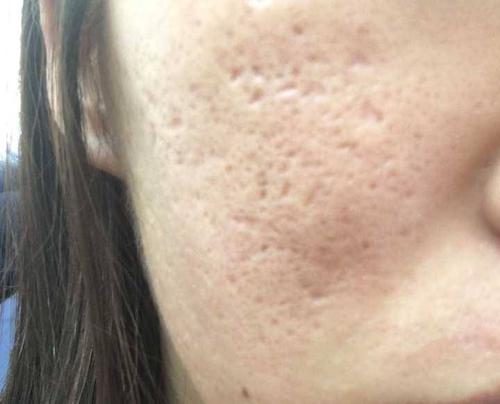 如何消灭痘痘?脸上的痘坑如何去除?方法都在这里