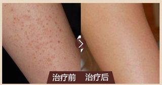 毛囊炎治疗后效果,来看真人案例_广州肤康皮肤病医院