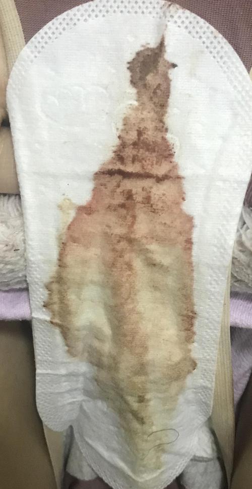 排卵期出血看起来很稀(有图)